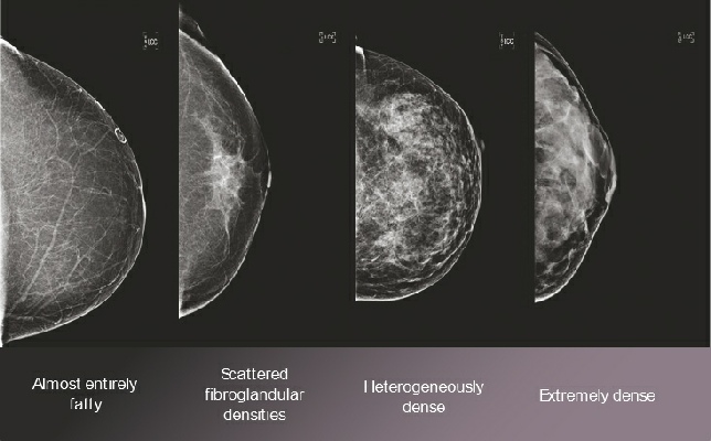 Breast density examples